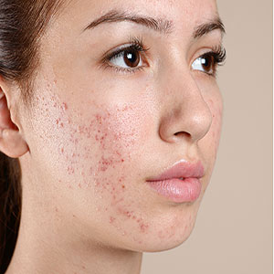 ACNE THERAPIE